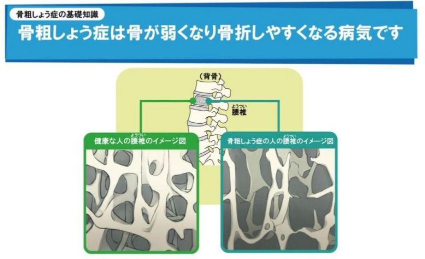 骨粗しょう症のイメージ図解