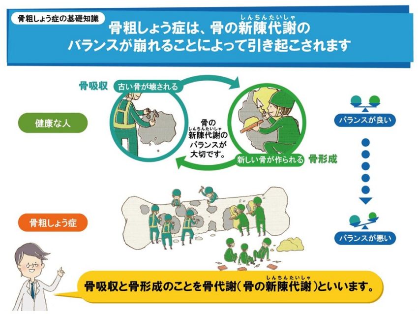 骨粗しょう症発生のメカニズム解説イラスト