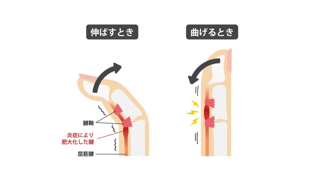 指の腱鞘炎、ばね指